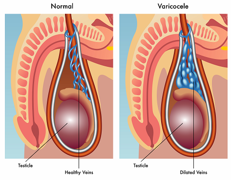 Varicocele diagram